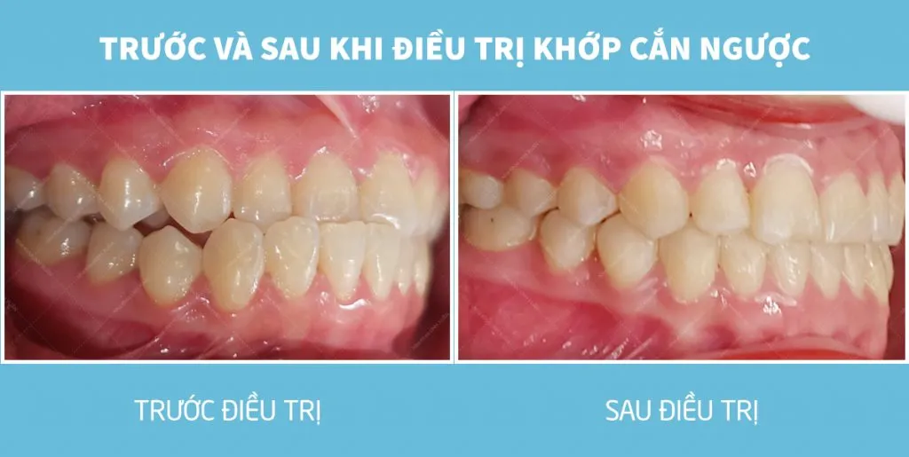 Niềng răng để sửa khớp cắn đối đầu mất bao lâu?