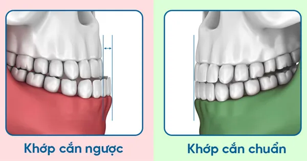 Phân biệt khớp cắn chuẩn và khớp cắn đối đầu: