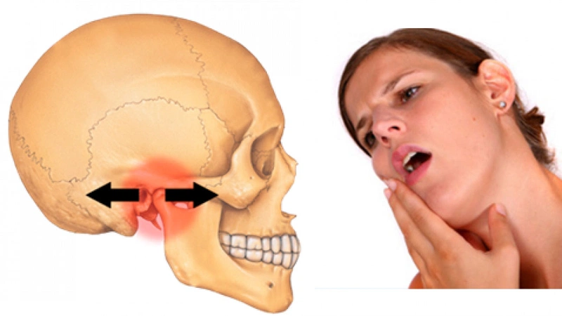 Viêm khớp thái dương hàm có tự khỏi không? Cách điều trị 10 Phương pháp điều trị viêm khớp thái dương hàm hiệu quả