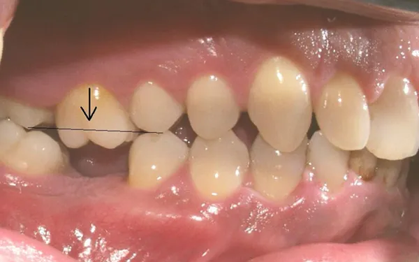 Tác hại của việc mất răng lâu năm