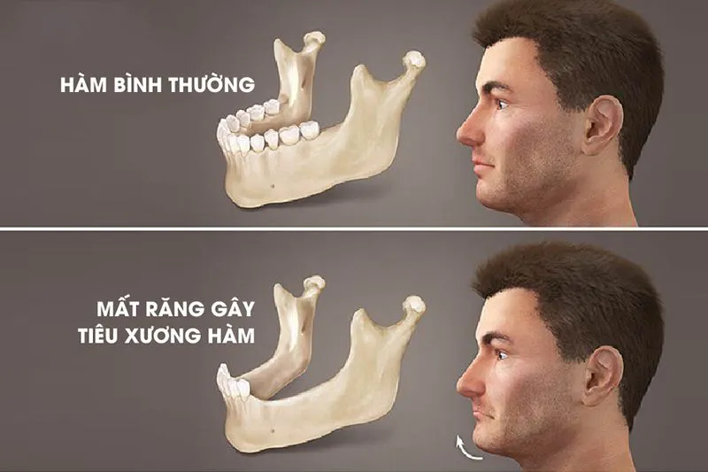 Tiêu xương hàm tại vị trí răng mất