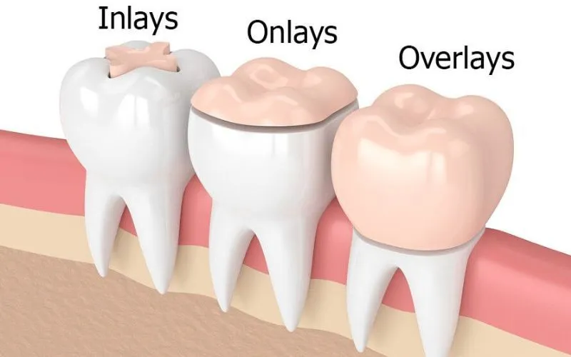 Trám răng Inlay, Onlay, Overlay là gì? Ưu nhược điểm