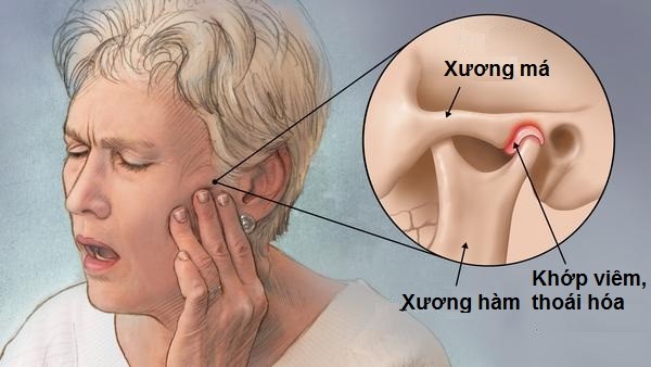 Viêm khớp thái dương hàm có tự khỏi không? Cách điều trị 8 Triệu chứng thường gặp của viêm khớp thái dương hàm