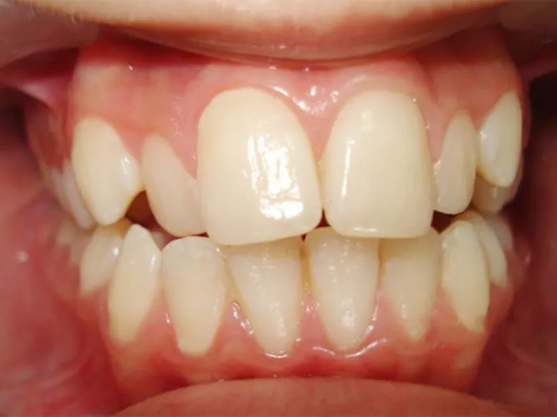 Vận mệnh người răng sở hữu răng cửa to và cách khắc phục 7 Vận mệnh của người có răng cửa to theo nhân tướng học