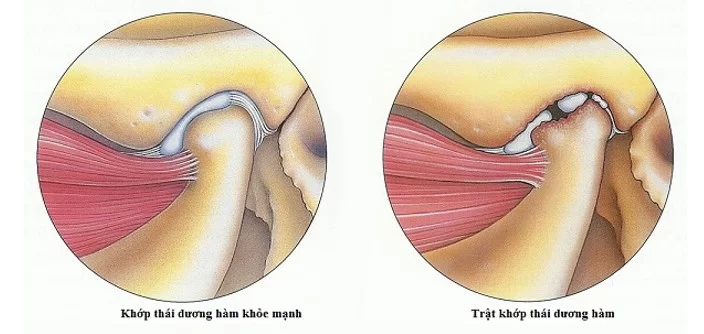 Viêm khớp thái dương hàm có tự khỏi không? Cách điều trị 9 Viêm khớp thái dương hàm có tự khỏi không?