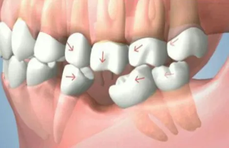 Xô lệch răng và sai khớp cắn