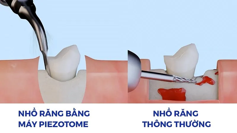 Nhổ răng bằng công nghệ Piezotome là gì?