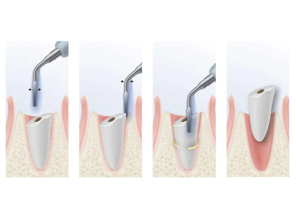 Máy piezotome là gì? Nhổ răng bằng Piezotome là gì?