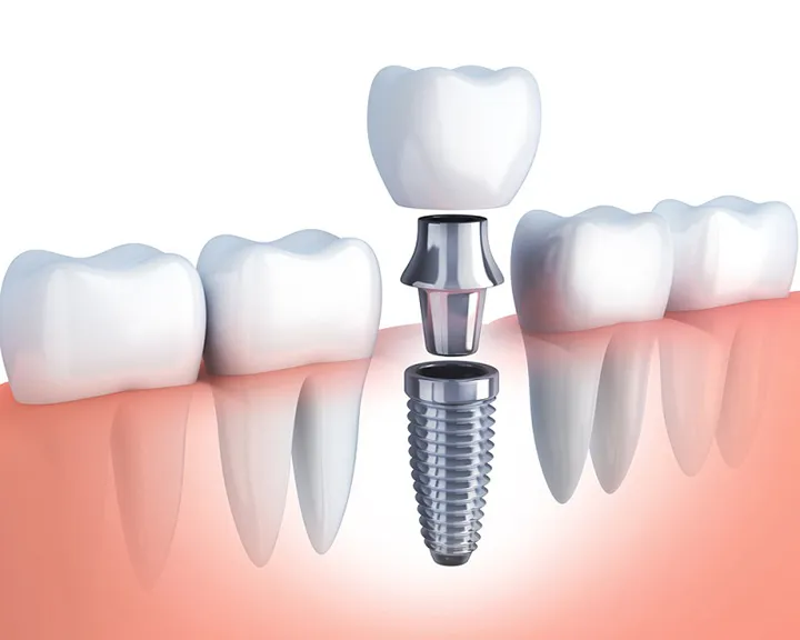 Cấy ghép Implant răng sứ