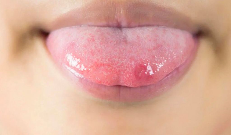 Các Triệu Chứng Thường Gặp Khi Nổi Mụn Đau Rát Ở Lưỡi