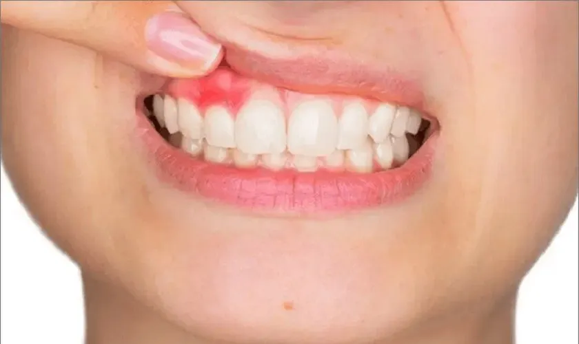 Cách xử lý tình trạng nổi cục cứng ở lợi không đau
