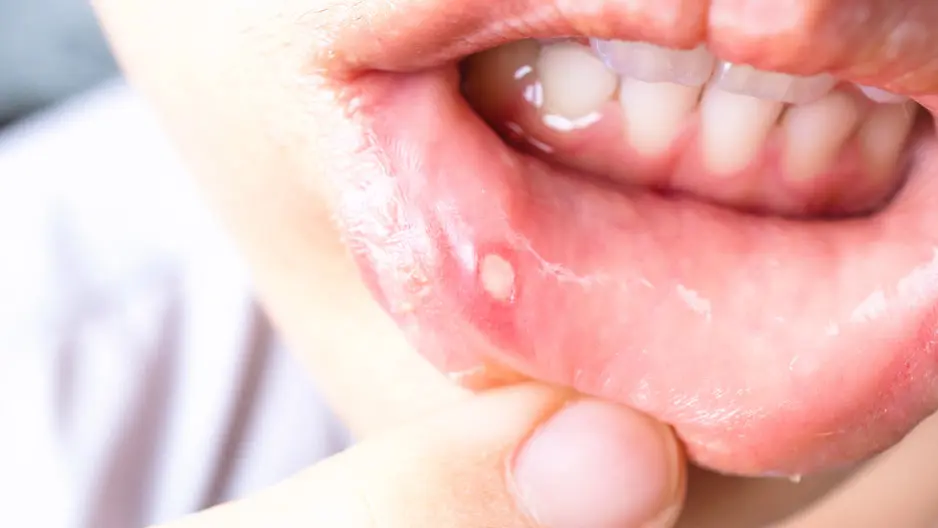 Hình ảnh viêm loét miệng ở trẻ: Nguyên nhân và cách trị 9 Dấu hiệu giúp cha mẹ nhận biết viêm loét miệng ở trẻ