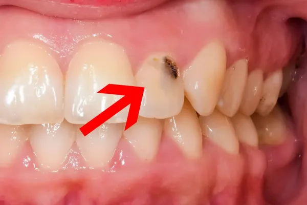 Nguyên Nhân Gây Vết Đen Giữa Kẽ Răng