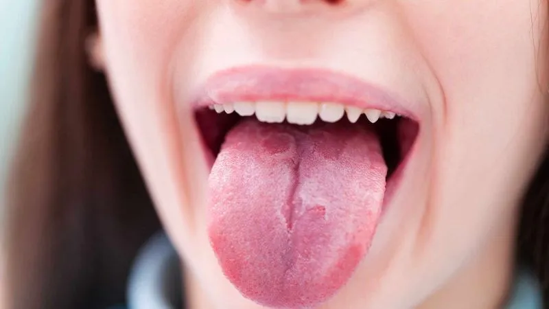 Nguyên nhân khiến bên trong má xuất hiện đường trắng