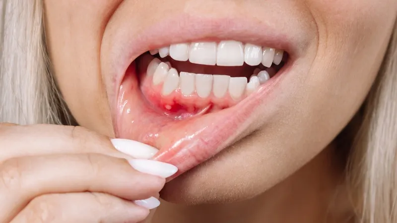 Nguyên nhân nổi cục cứng ở lợi không đau