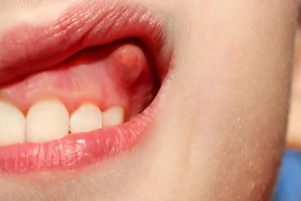 Nổi cục cứng ở lợi không đau: Nguyên nhân và cách xử lý