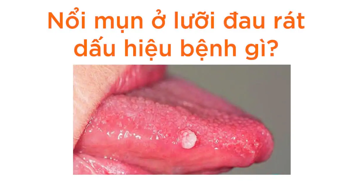 Nổi mụn ở lưỡi đau rát là bệnh gì? Nguyên nhân và cách trị