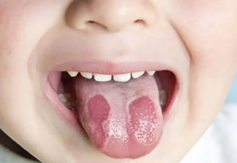 rộp lưỡi ở trẻ em