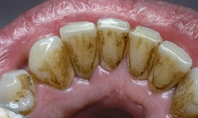 Vết đen giữa kẽ răng là gì? Nguyên nhân và cách khắc phục