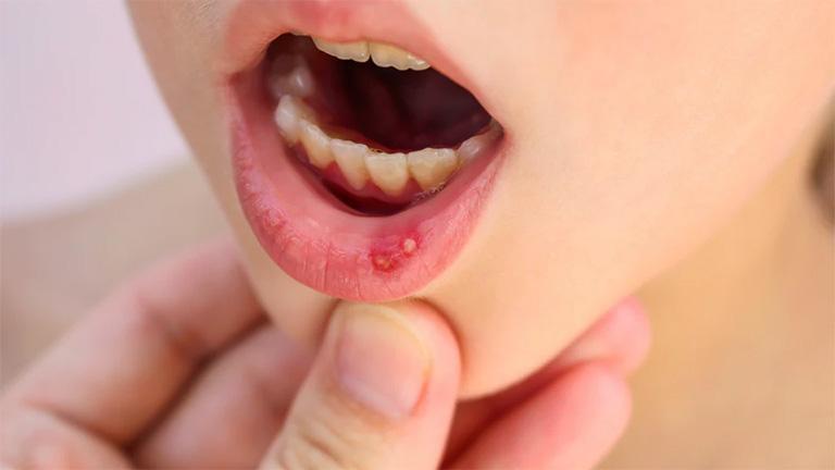 Hình ảnh viêm loét miệng ở trẻ: Nguyên nhân và cách trị 7 Viêm loét miệng ở trẻ là gì