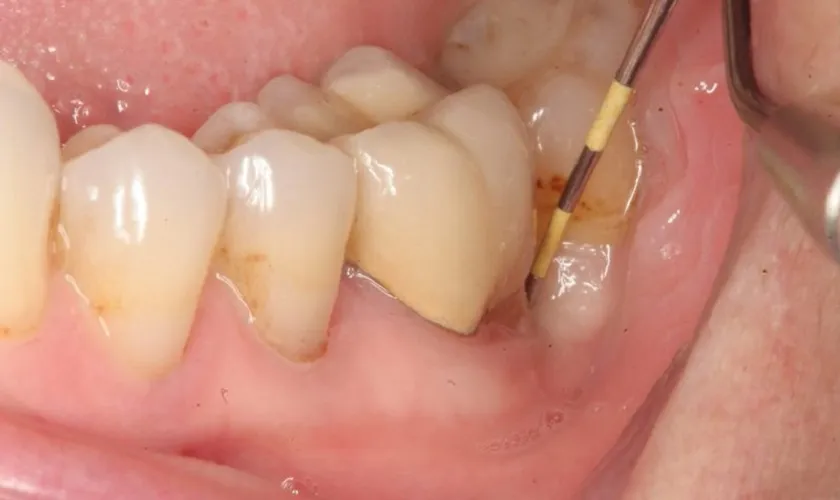 4 loại thuốc kháng sinh điều trị viêm chân răng phổ biến